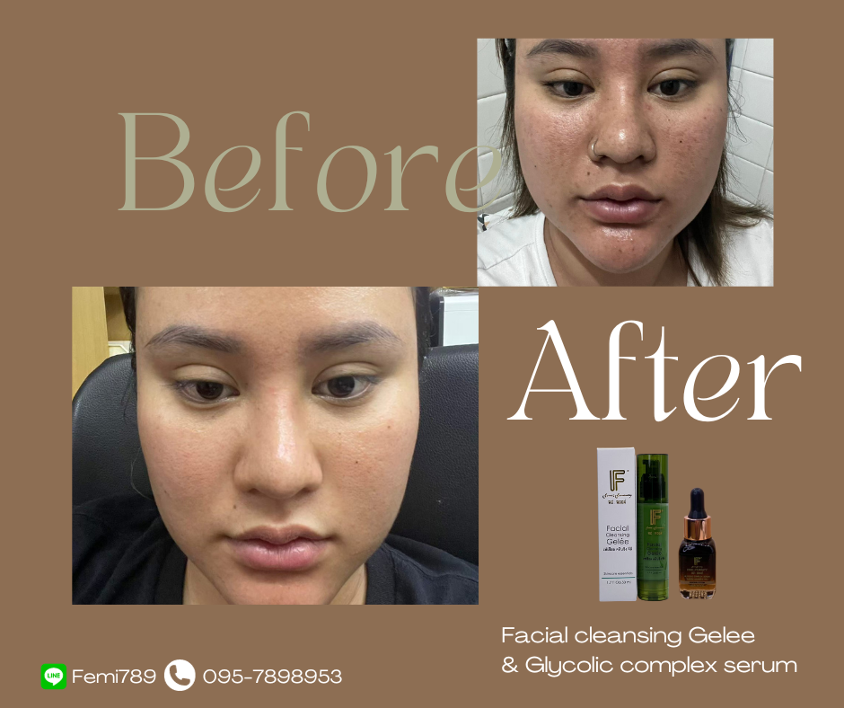 ภาพขนาดย่อ: เซ็ตแก้สิว