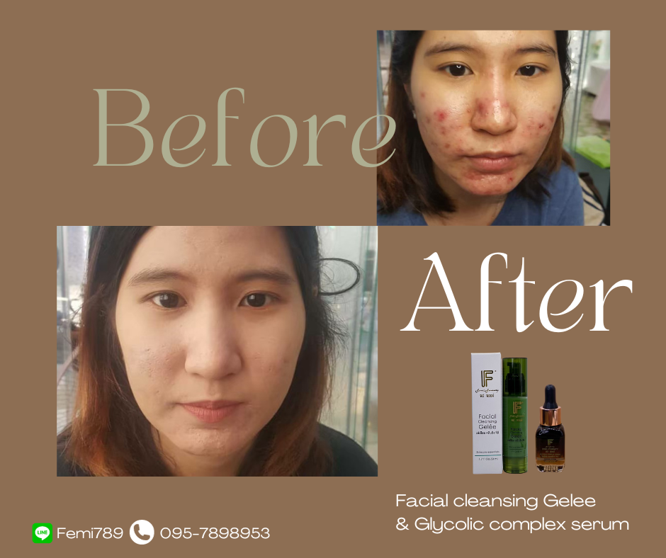 ภาพขนาดย่อ: เซ็ตแก้สิว