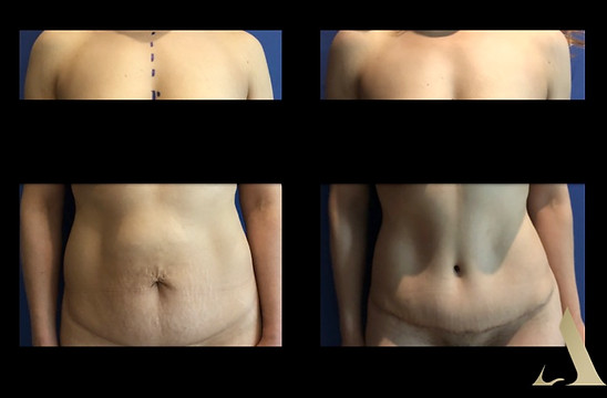 abdominoplastia mexico alberto trapassi ciudad de mexico abdomen plano