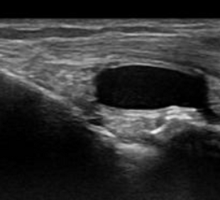 Musculoskeletal MSK scan showing a fluid-filled cyst.