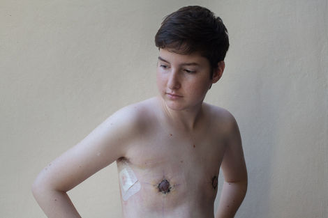 A photograph of a young man from the chest upwards. There are surgical scars visible on the chest.