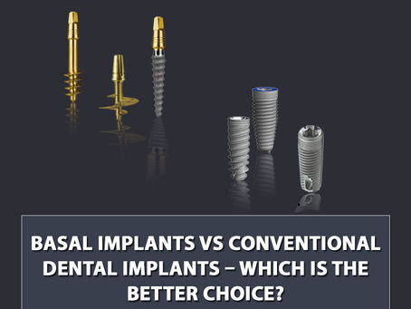 Basal Implants Vs Conventional Dental Implants – Which is the Better Choice?