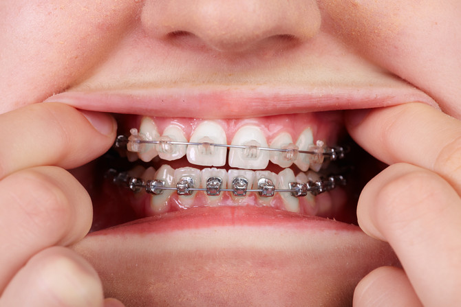 Clear Braces vs. Metal Braces.