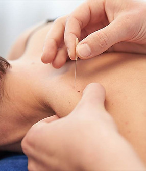 Dry Needling