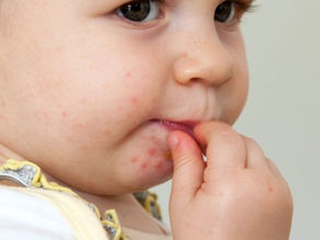 Hand, Foot, and Mouth Disease: What You Need to Know