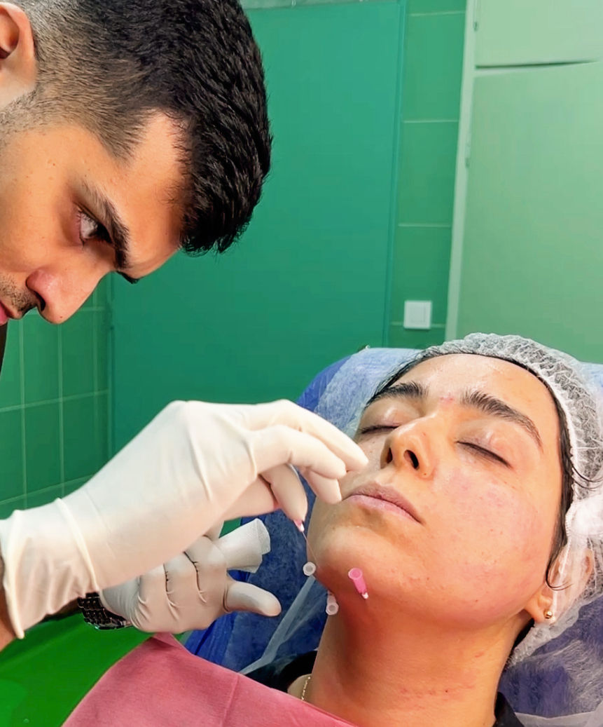 Thread lift H_edited_edited