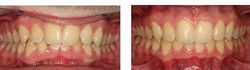 invisalign before or after