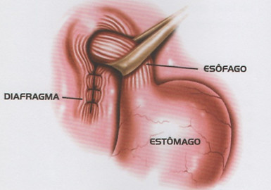 fundoplicatura