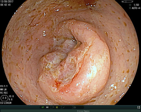 tumor de intestino