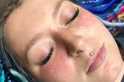 Tattooing-Freckles_1.jpg