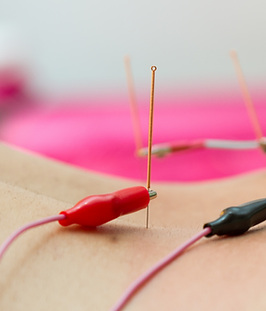small black and red electrodes are hooked up to acupuncture needles on a person's back