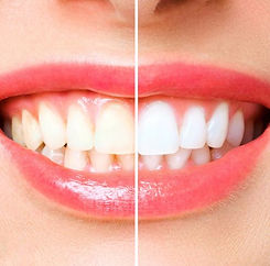 clareamento dental