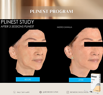 Before and After PLINEST Treatment