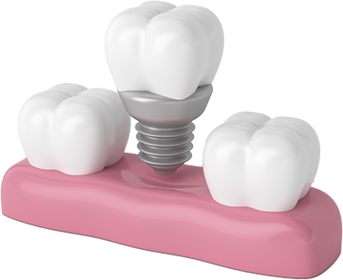 Implantes dentários