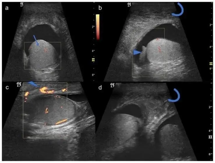 Gray scale and colour Doppler ultrasonography of the scrotum