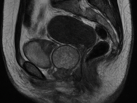 MRI-Targeted or Standard Biopsy for Prostate-Cancer Diagnosis