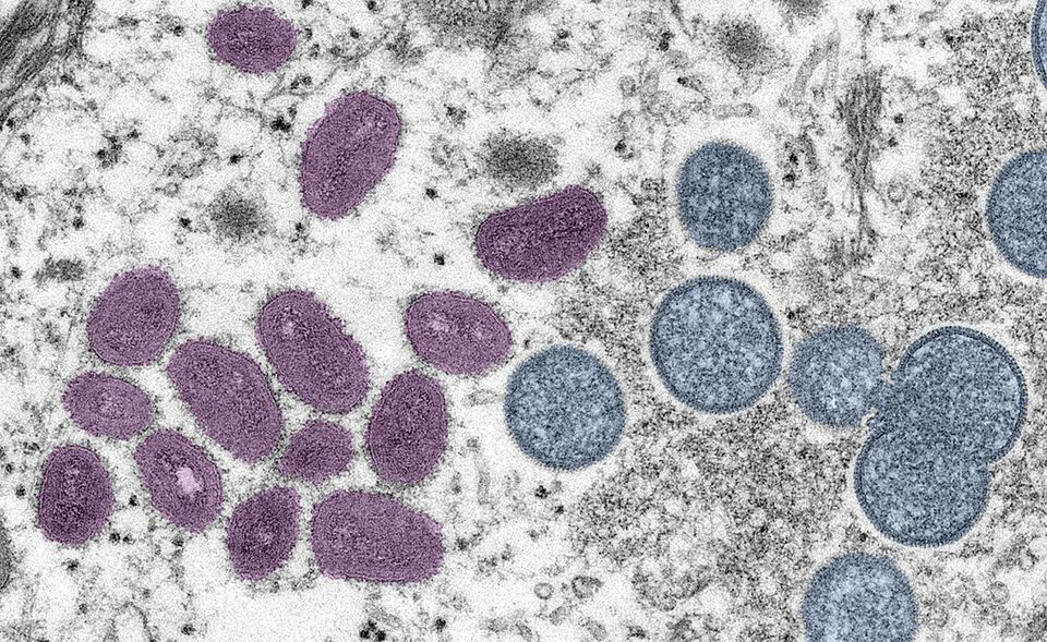 Mpox: Understanding the Virus Behind the Latest Global Health Alert