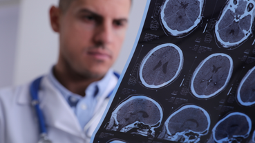 Addressing Acute Ischemic Stroke in Germany: Advances and InitiativesÂ