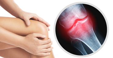 Diagnosis and Management of Metabolic Bone Disorders in Canada and LATAM 