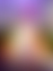 Astigmatism: the eye’s shape causes blurred or distorted vision at all distances