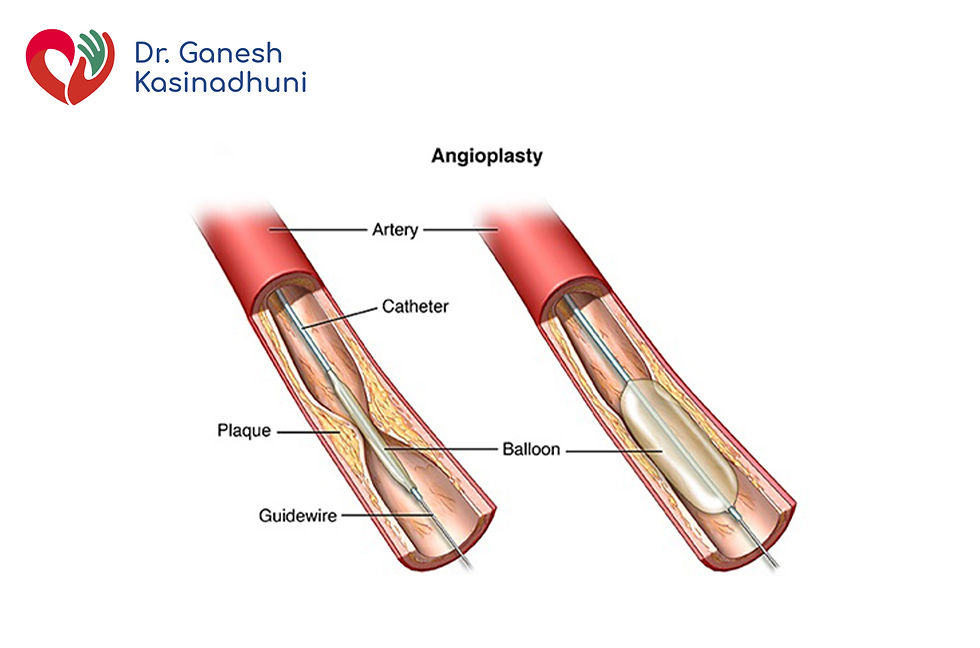 Angioplasty
