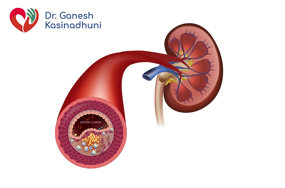 Blockage in Renal Arteries