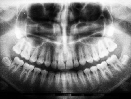 Panoramic Dental X-Ray