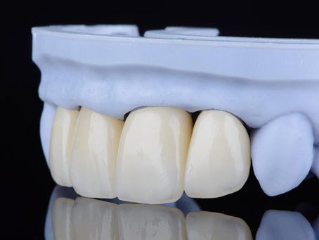 Dental Crowns and Bridges in Dubai