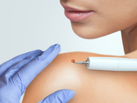 Skin Wart Removal Cost in Dubai