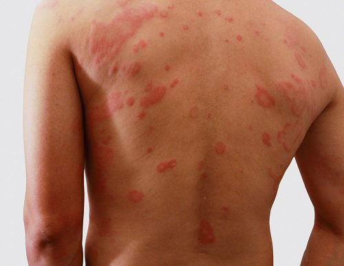 Dermatitis Atópica
