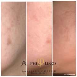 Spots treatment 2.JPG