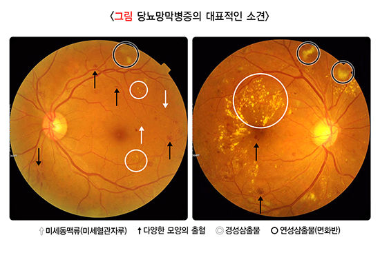 마운자로 실명? 시야 흐림 원인과 주의가 필요한 경우