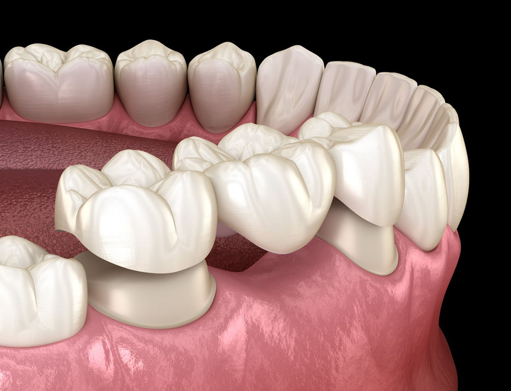 The 5 less invasive alternatives to dental implants Dental Centre