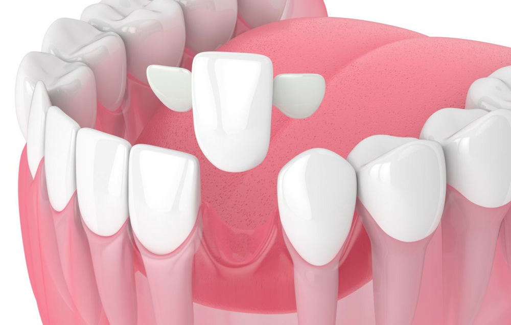 The 5 less invasive alternatives to dental implants Dental Centre
