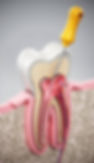 Dental file inside tooth root canal space illustrating root canal treatment procedure.