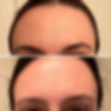 Thumbnail: Forehead & Between Eyes Wrinkle Patches