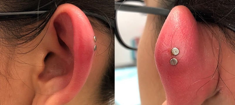 kulak piercingi enfeksiyon bakımı nasıl yapılır