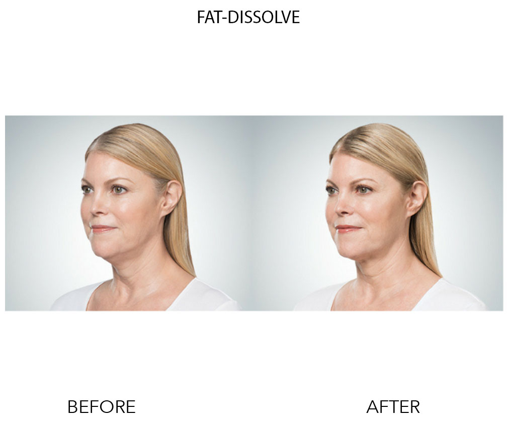 Chin Fat Dissolve Newcastle Cosmetic Medicine