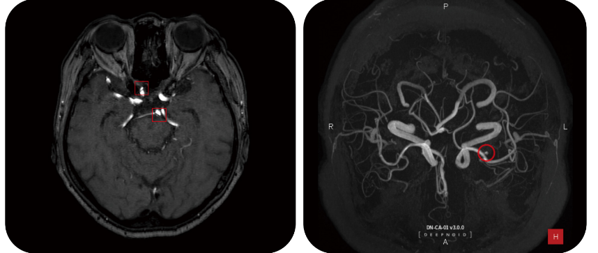 [사진1] 딥뉴로 판독화면
