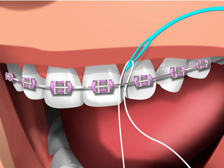 O uso do fio dental na ortodontia fixa