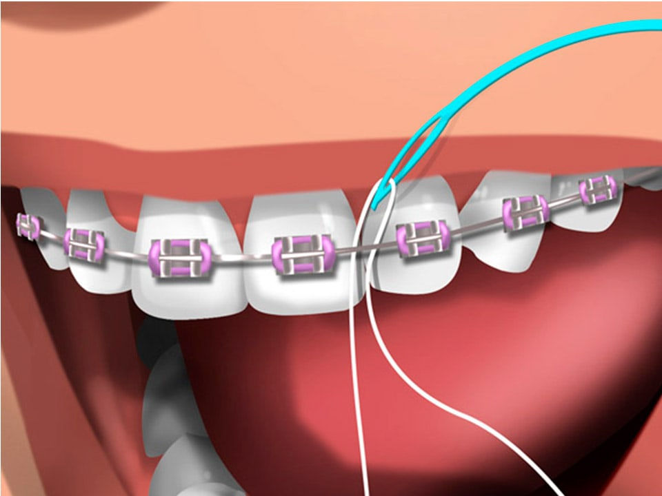 O uso do fio dental na ortodontia fixa