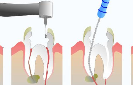 Desmistificando a Endodontia