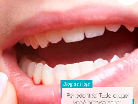 Periodontite – Tudo o que você precisa saber