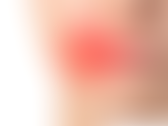Laserterapia contra herpes labial