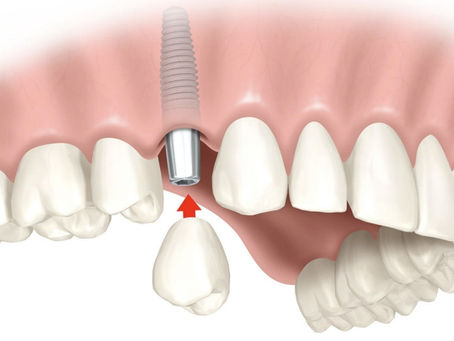 Saiba mais sobre implante dental