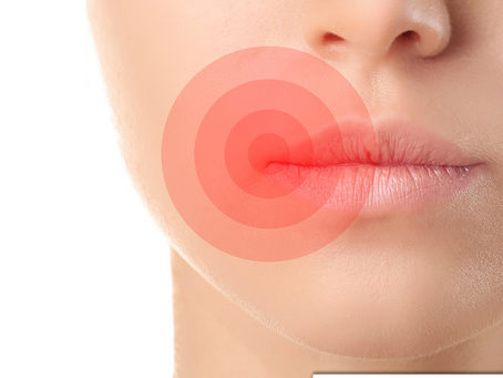 Laserterapia contra herpes labial