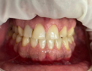 Odontologia Estética - Lentes de Resina Direta - Dentista na Vila Mariana - Dentista perto de mim