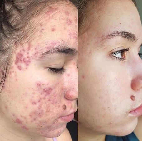 ACNELAN - FOR DEG SOM HAR PRØVD ALT