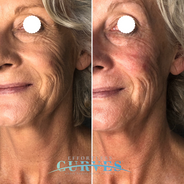 Clients first session with Alpha Shape PRO. Notice the incredible result in both skin tightening and wrinkle reduction despite no heavy make up in the after photo. ๐