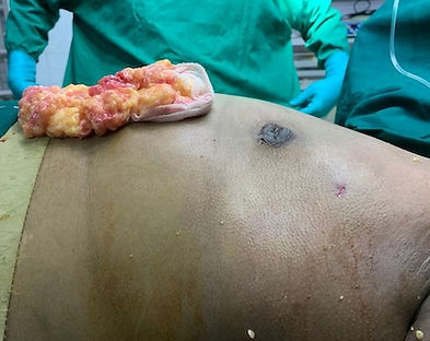 Step 2: Limited-access gland excision to keep scars minimal
